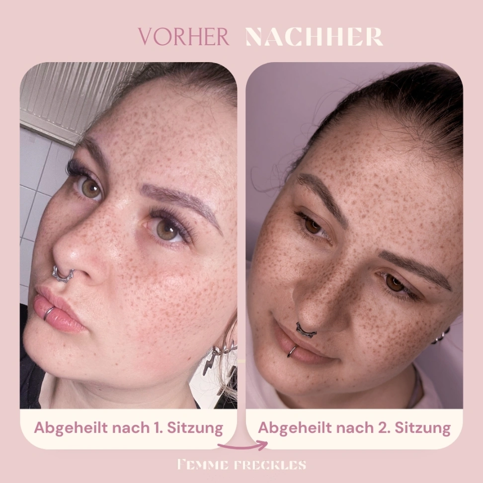 Fake Freckles - So natürlich sehen unechte Sommersprossen abgeheilt aus