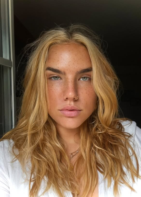 Anna mit abgeheilten Fake Freckles