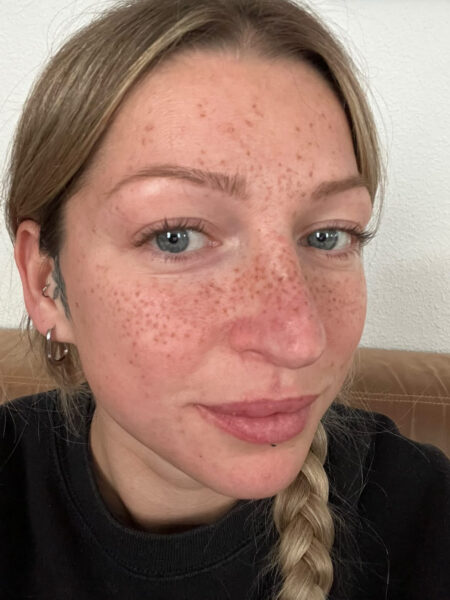 Alina nach drei Sitzungen